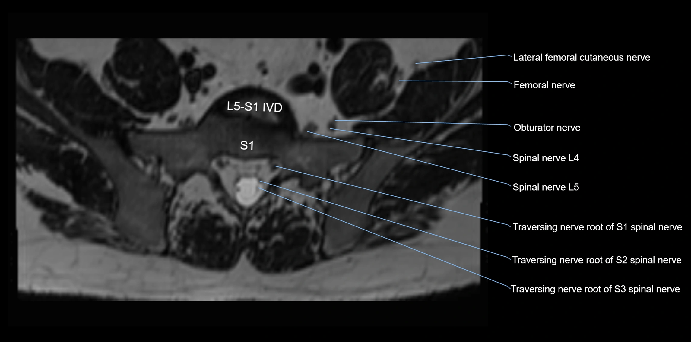 MR lumbosacral plexus axial cross sectional anatomy 3T  radiology  image-img-1008001-00068.webp
